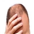 بهترین راه درمان ریزش موی مردان , استفاده از ماینوکسیدیل و فیناستراید