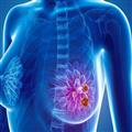 کشف یک داروی جدید برای درمان شایعترین نوع سرطان سینه 