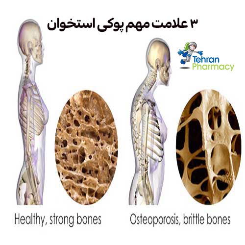  3 علامت مهم پوکی استخوان را بشناسید