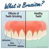 علل و راه‌ های درمان دندان قروچه چیست؟